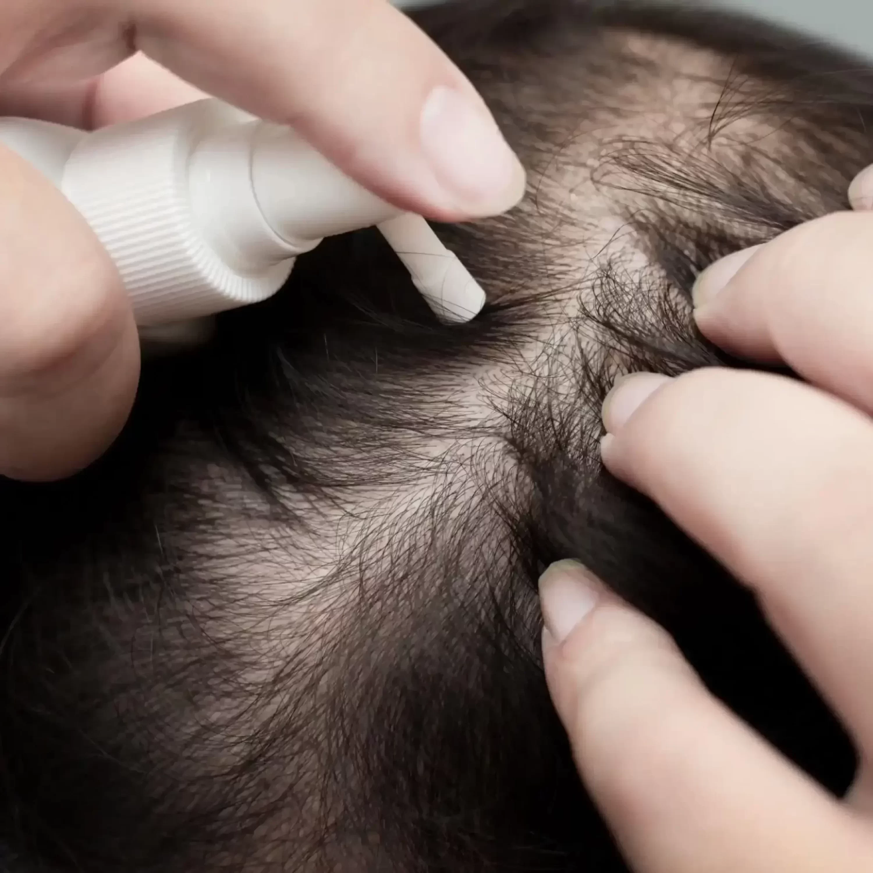 Hair Loss Treatment